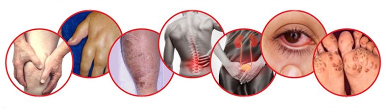 Artriti reaktiv: Simptomat, faktorët e rrezikut, trajtimi dhe parandalimi