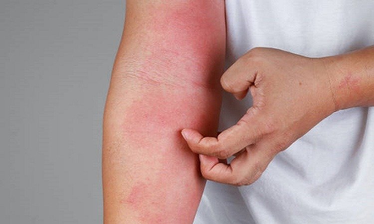 Situata me viruset është qetësuar, por janë shtuar kontrollet për alergji sezonale